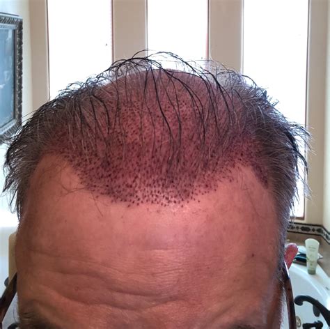 precision medical hair restoration